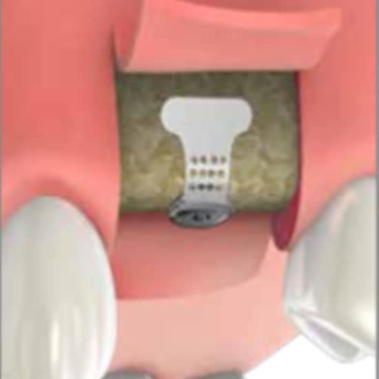SAFETY IMPLANT MEMBRANE